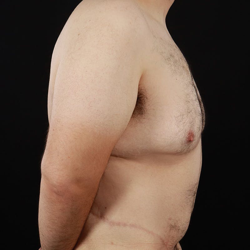 Body Contouring Before & After Gallery - Patient 314246 - Image 5