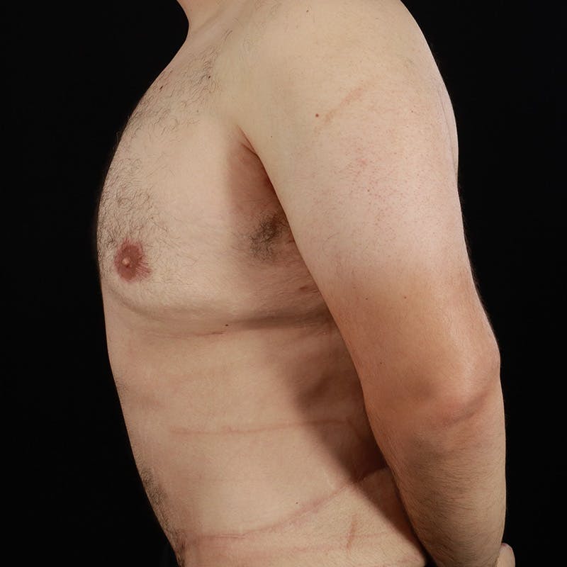 Male Liposuction Before & After Gallery - Patient 381319 - Image 10