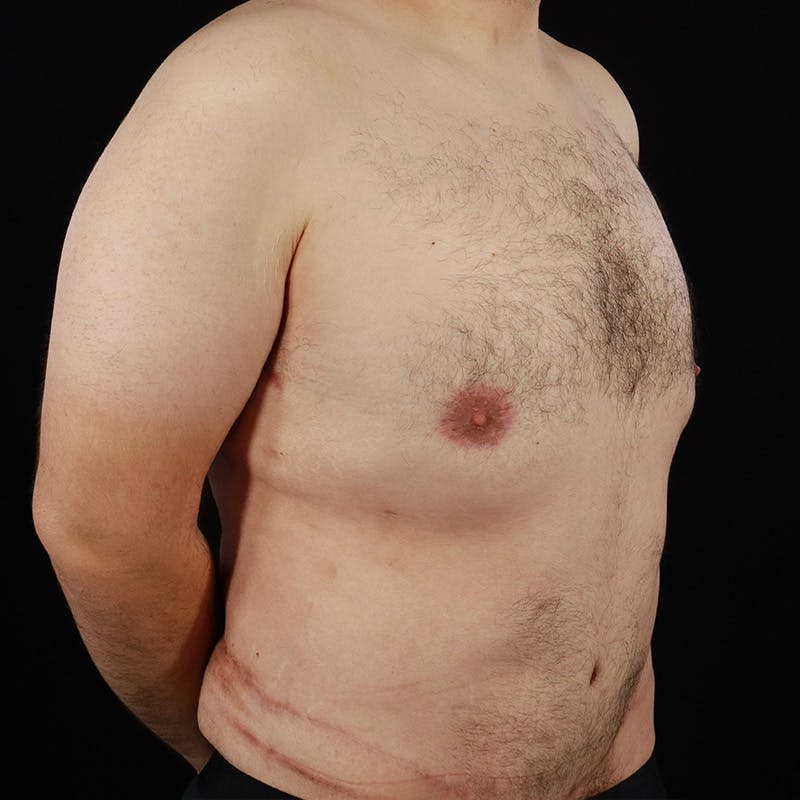 Gynecomastia Before & After Gallery - Patient 275896 - Image 4