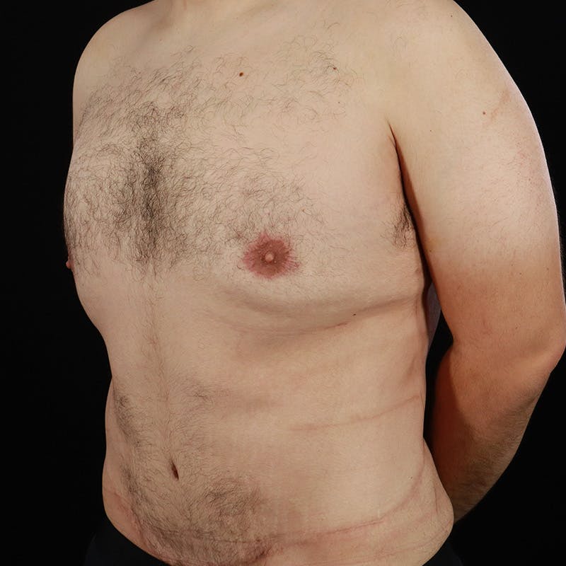 Body Contouring Before & After Gallery - Patient 314246 - Image 8