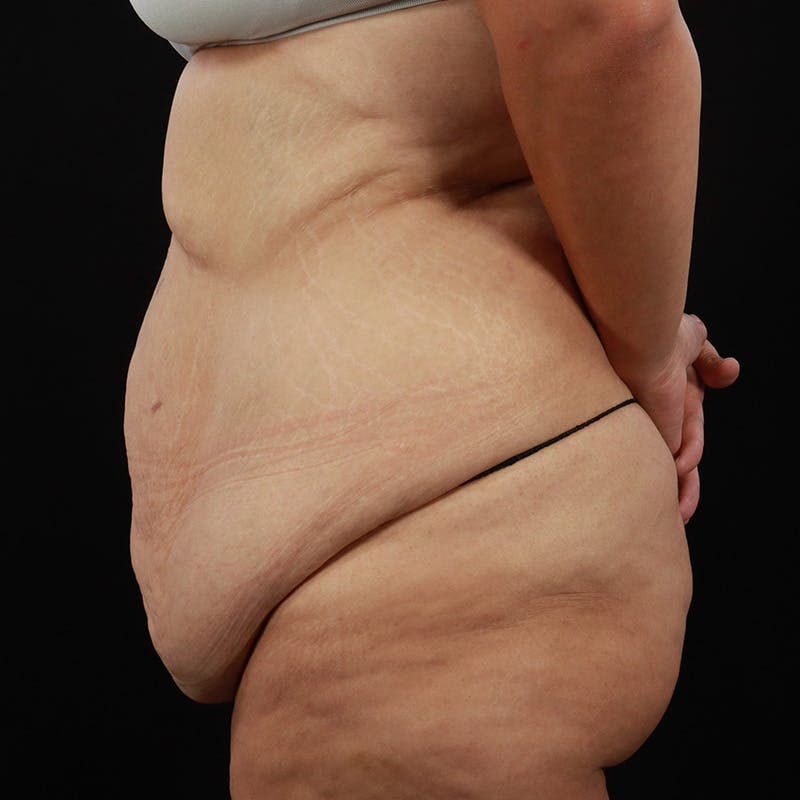 Body Lift Before & After Gallery - Patient 142221 - Image 13