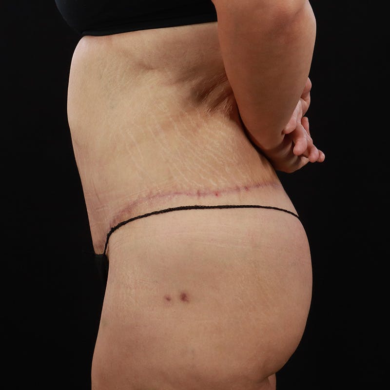 Body Lift Before & After Gallery - Patient 142221 - Image 14