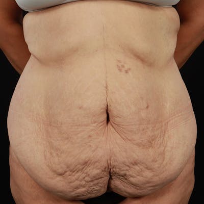 Body Lift Before & After Gallery - Patient 142221 - Image 1