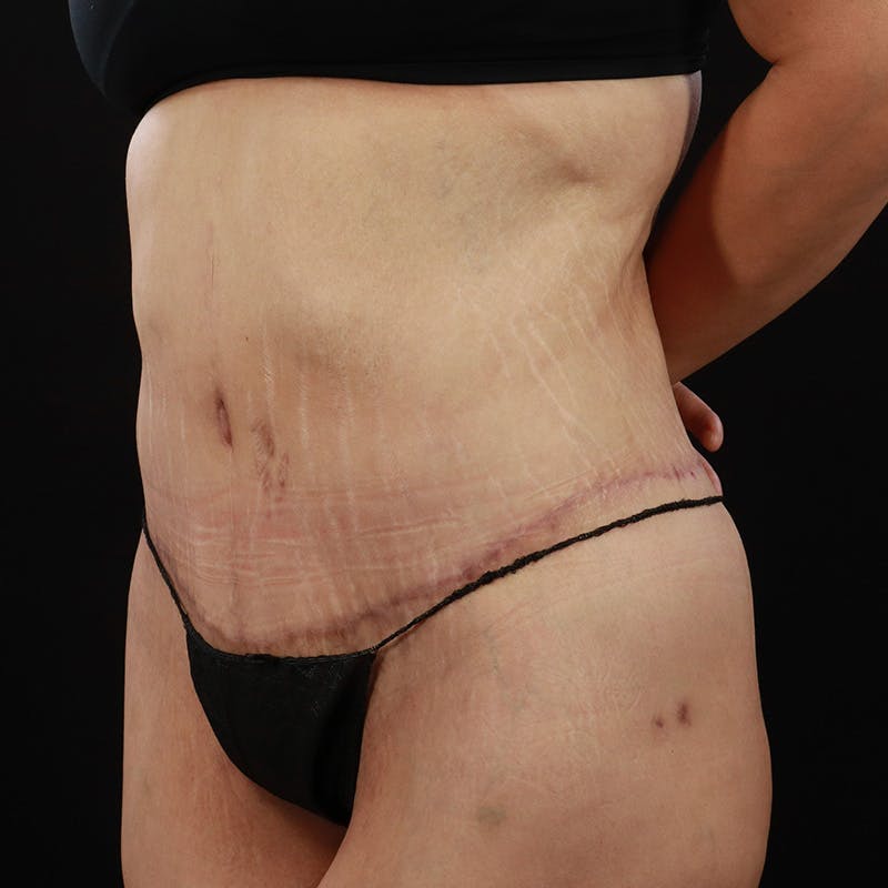 Body Lift Before & After Gallery - Patient 142221 - Image 16