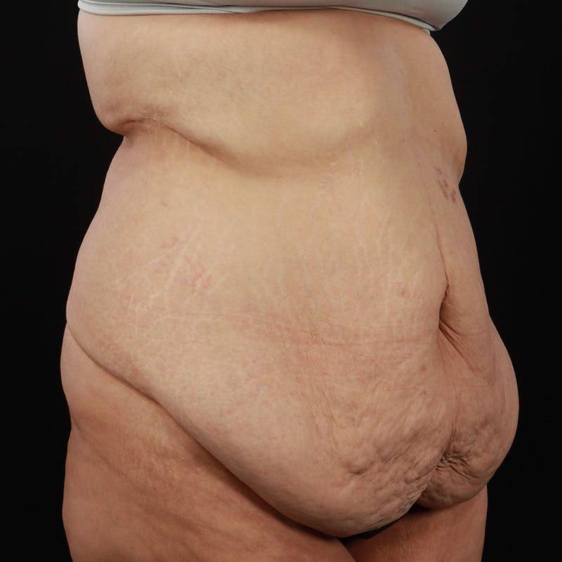Body Lift Before & After Gallery - Patient 142221 - Image 3