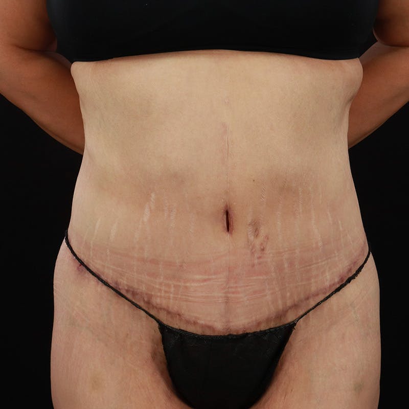 Body Lift Before & After Gallery - Patient 142221 - Image 2