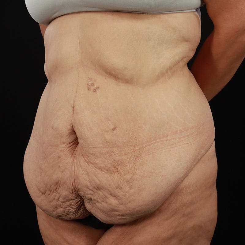 Body Lift Before & After Gallery - Patient 142221 - Image 15