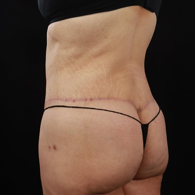 Body Lift Before & After Gallery - Patient 142221 - Image 12