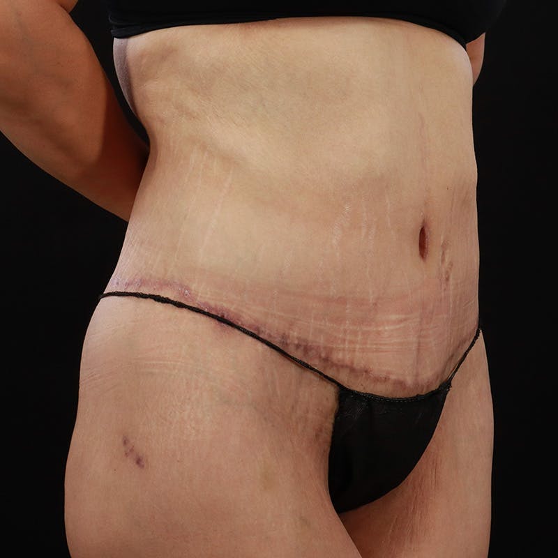 Body Lift Before & After Gallery - Patient 142221 - Image 4