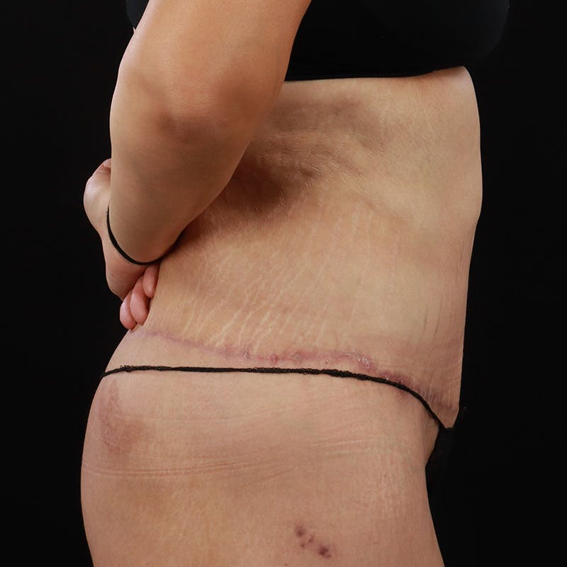 Body Lift Before & After Gallery - Patient 142221 - Image 6