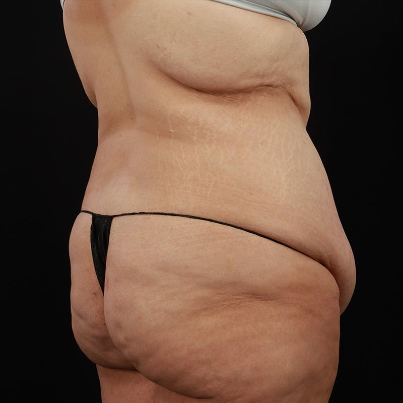 Body Lift Before & After Gallery - Patient 142221 - Image 7