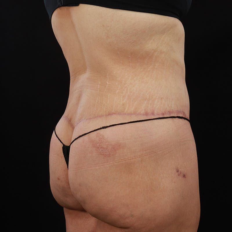 Body Lift Before & After Gallery - Patient 142221 - Image 8