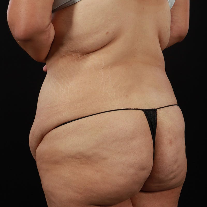 Body Lift Before & After Gallery - Patient 142221 - Image 11