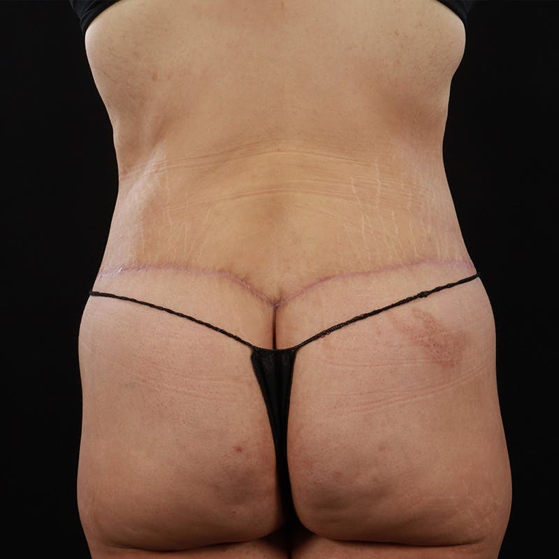 Body Lift Before & After Gallery - Patient 142221 - Image 10