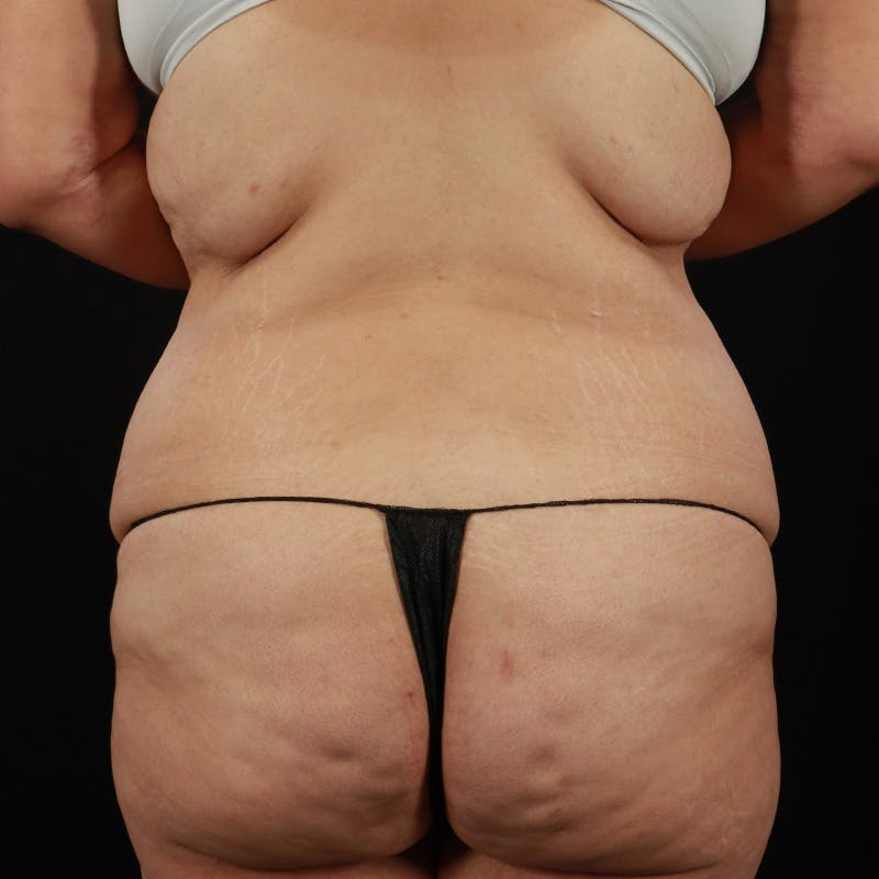 Body Lift Before & After Gallery - Patient 142221 - Image 9