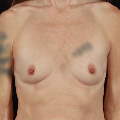 Breast Augmentation Before & After Gallery - Patient 623369 - Image 1