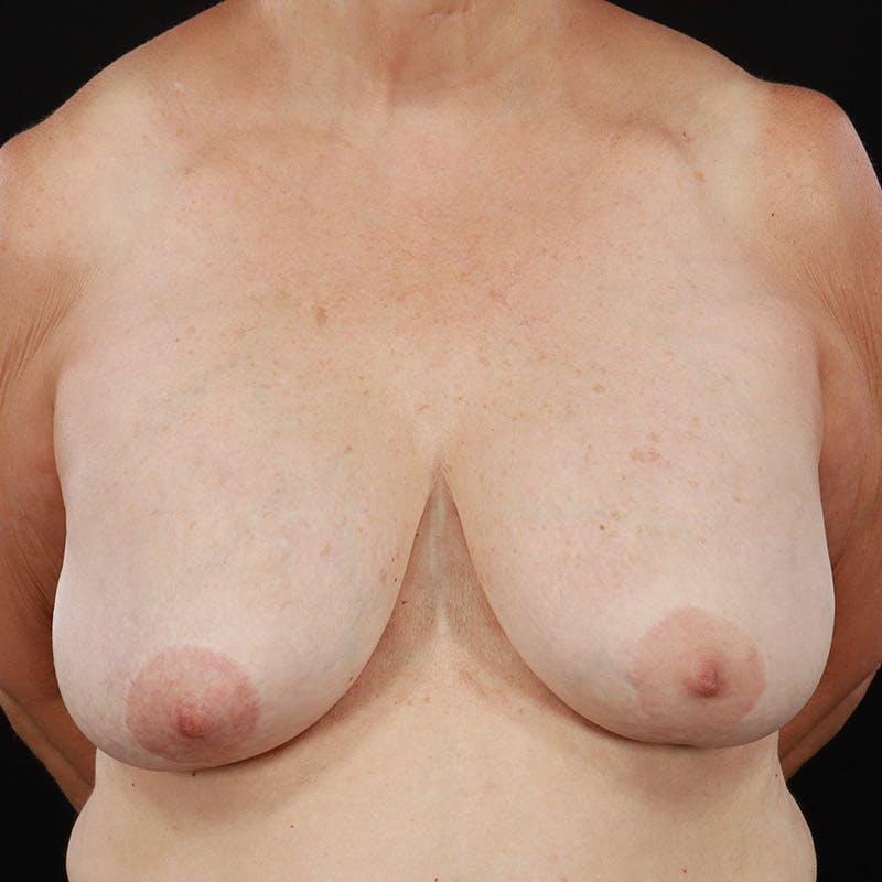 Breast Explant with Lift Before & After Gallery - Patient 395445 - Image 3