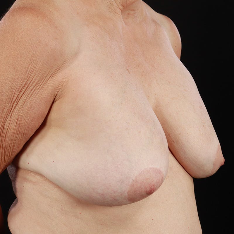 Breast Explant with Lift Before & After Gallery - Patient 395445 - Image 5