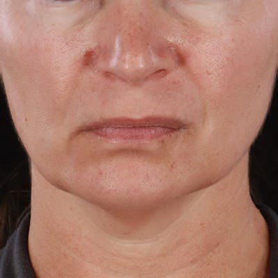 Lip Lift Before & After Gallery - Patient 221955 - Image 1