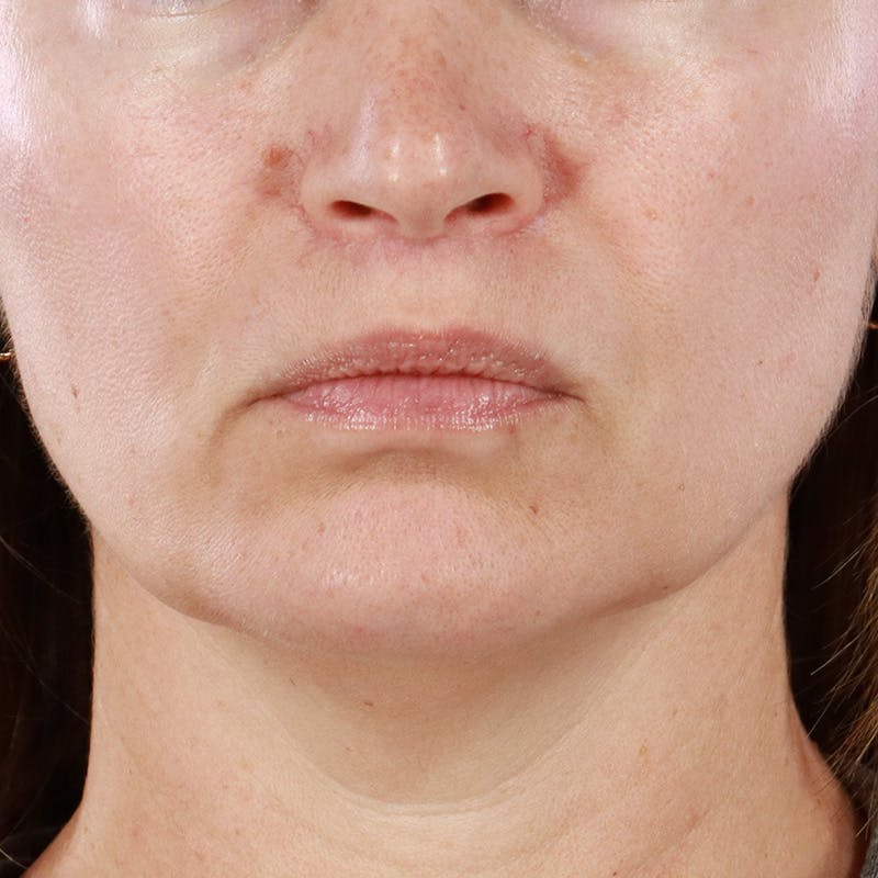 Lip Lift Before & After Gallery - Patient 221955 - Image 2