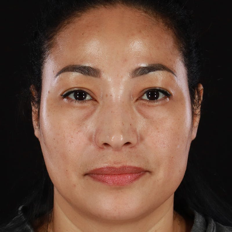 Lower Eyelid Surgery Before & After Gallery - Patient 258708 - Image 1