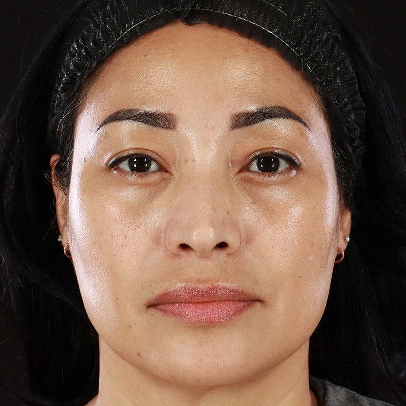 Lower Eyelid Surgery Before & After Gallery - Patient 258708 - Image 2