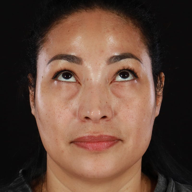Lower Eyelid Surgery Before & After Gallery - Patient 258708 - Image 3