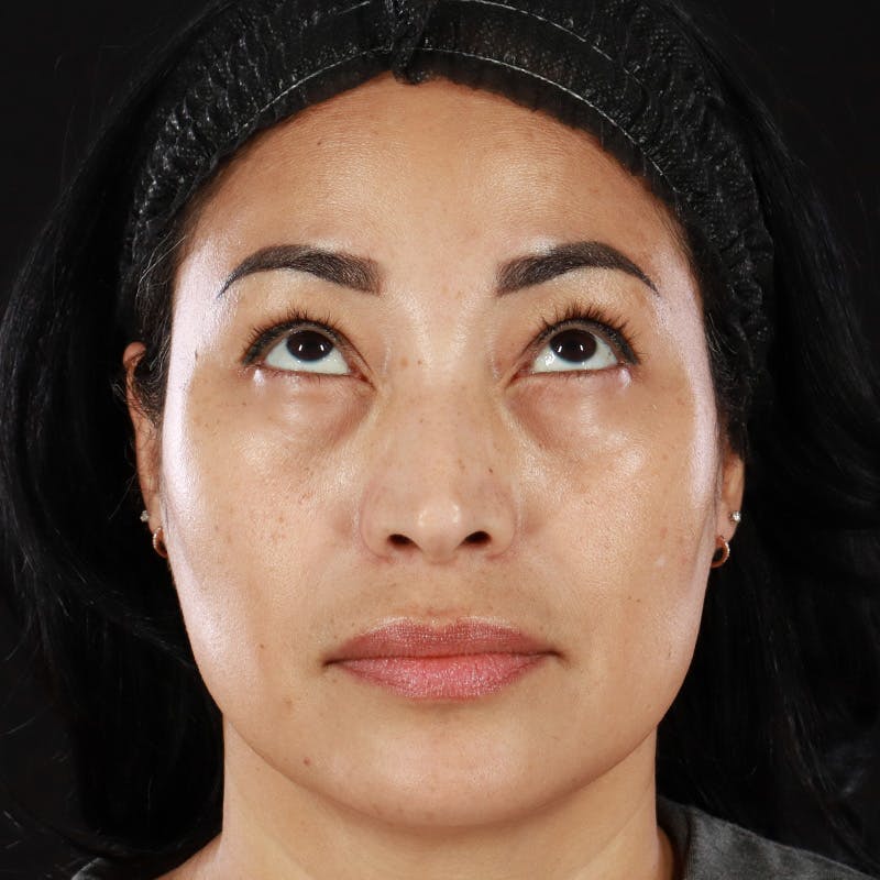 Lower Eyelid Surgery Before & After Gallery - Patient 258708 - Image 4