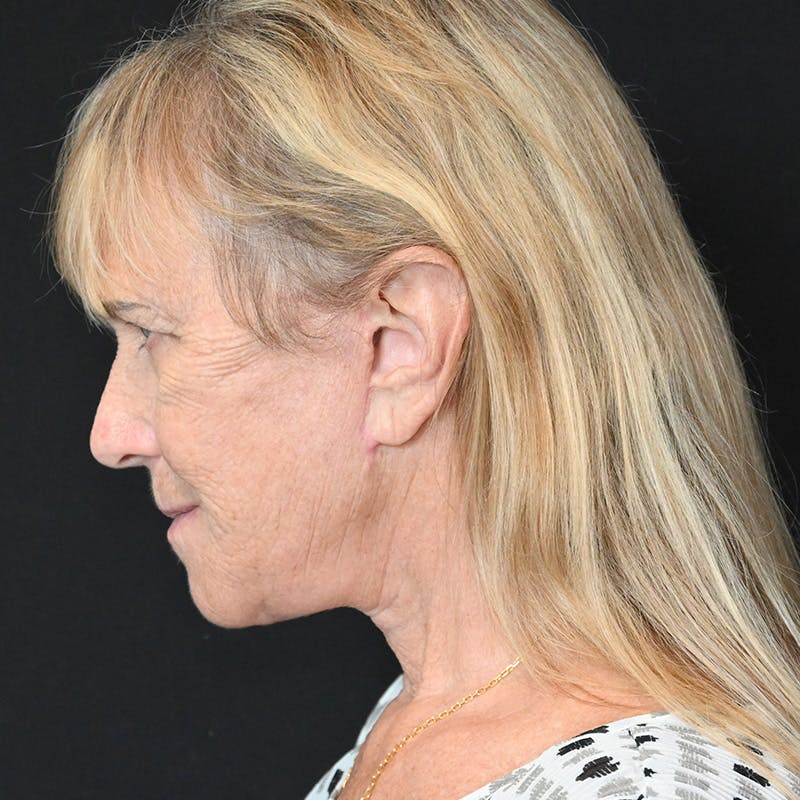 Facelift Before & After Gallery - Patient 169568 - Image 14