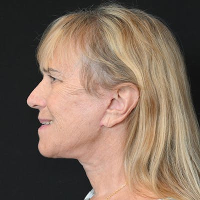 Neck Lift Before & After Gallery - Patient 651671 - Image 2