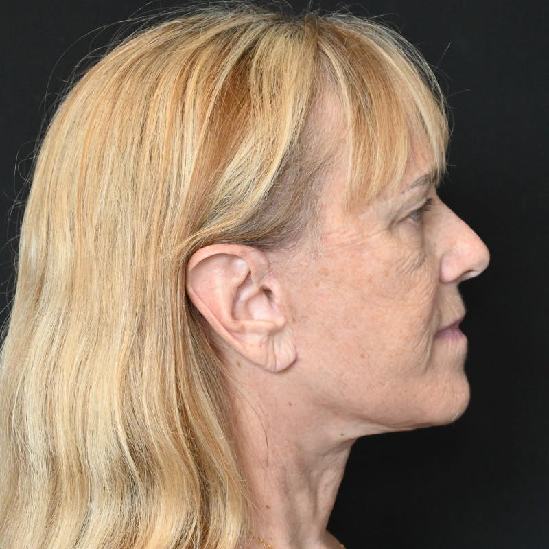 Facelift Before & After Gallery - Patient 169568 - Image 6