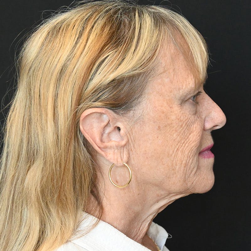 Facelift Before & After Gallery - Patient 169568 - Image 5