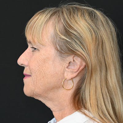 Neck Lift Before & After Gallery - Patient 651671 - Image 1