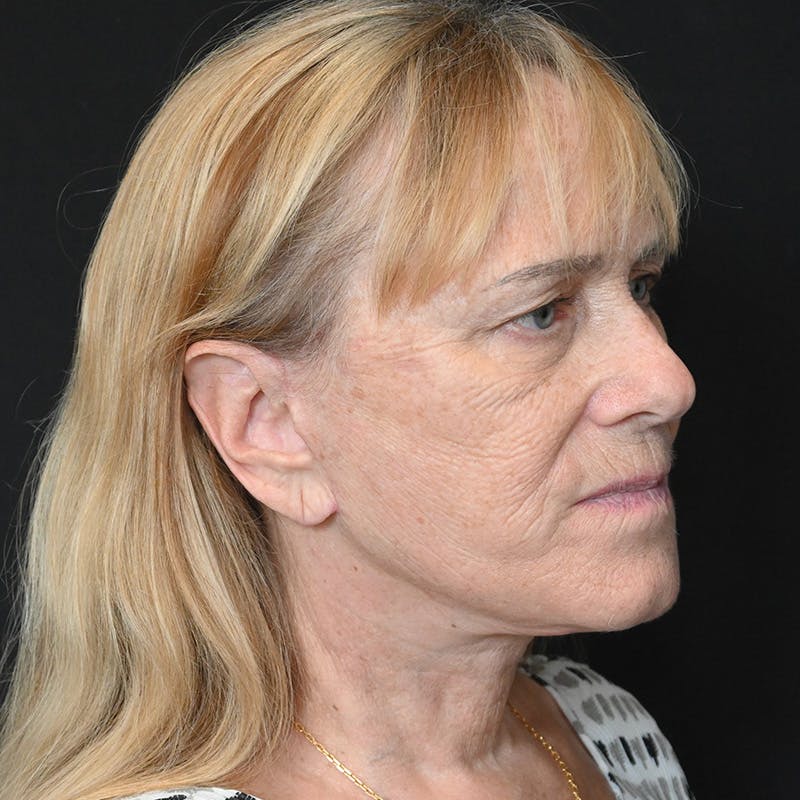 Facelift Before & After Gallery - Patient 169568 - Image 4