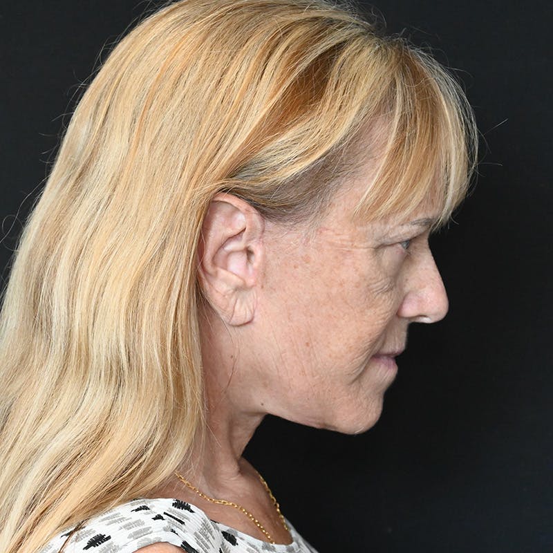 Neck Lift Before & After Gallery - Patient 651671 - Image 10