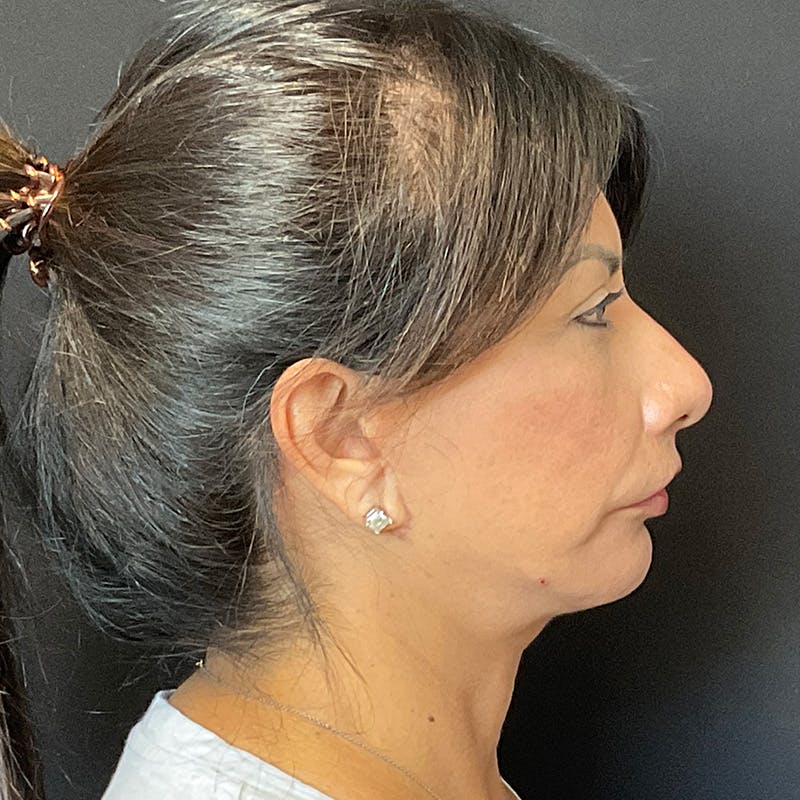 Neck Lift Before & After Gallery - Patient 118850 - Image 10