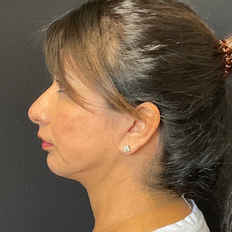 Neck Lift Before & After Gallery - Patient 118850 - Image 2