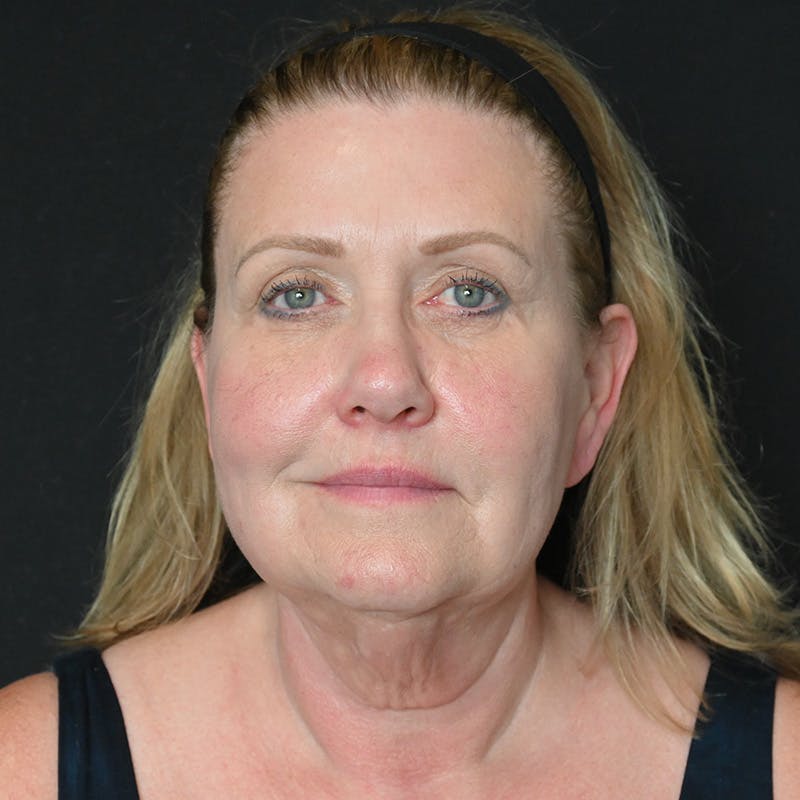 Neck Lift Before & After Gallery - Patient 341446 - Image 3
