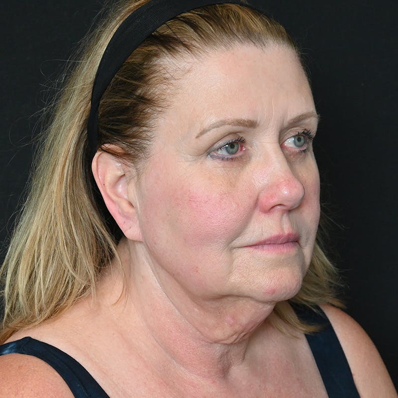 Facelift Before & After Gallery - Patient 242279 - Image 3