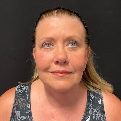 Facelift Before & After Gallery - Patient 242279 - Image 2
