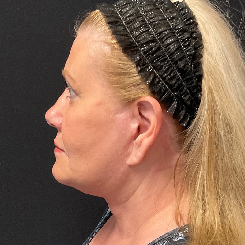 Neck Lift Before & After Gallery - Patient 341446 - Image 2