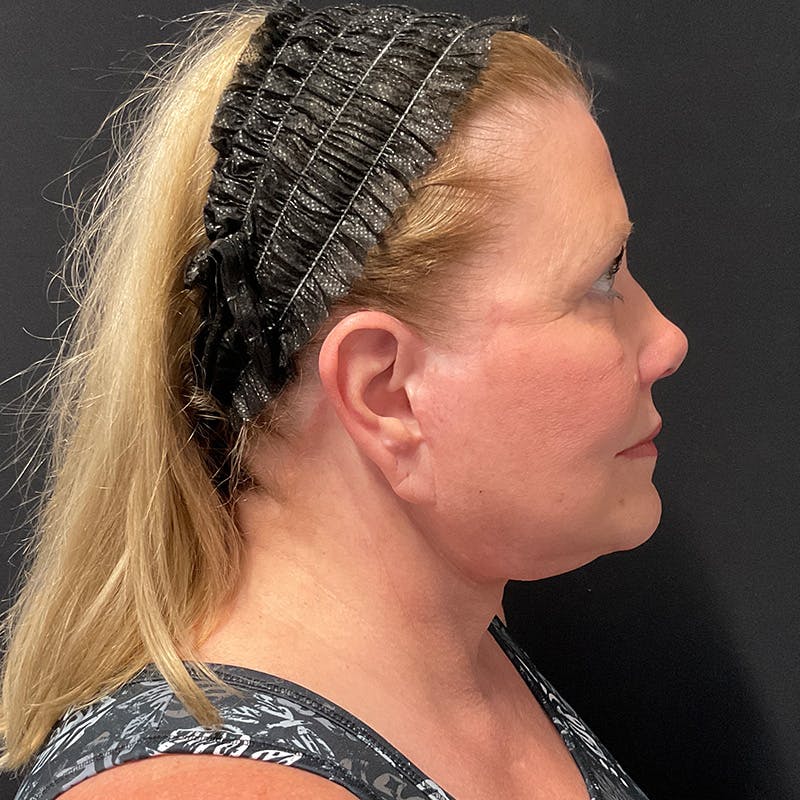 Neck Lift Before & After Gallery - Patient 341446 - Image 8