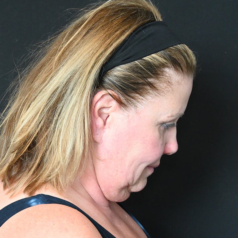 Neck Lift Before & After Gallery - Patient 341446 - Image 9