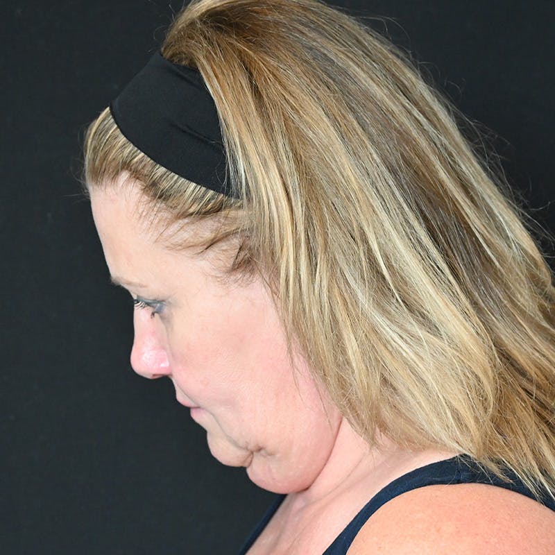 Neck Lift Before & After Gallery - Patient 341446 - Image 13