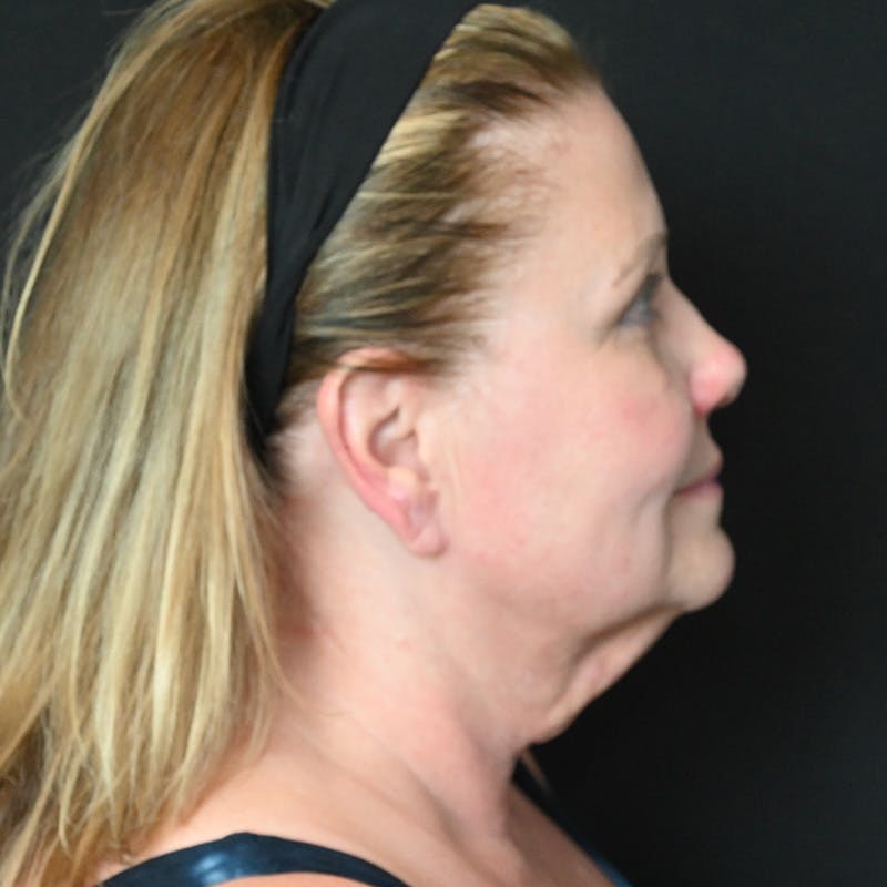 Neck Lift Before & After Gallery - Patient 341446 - Image 7