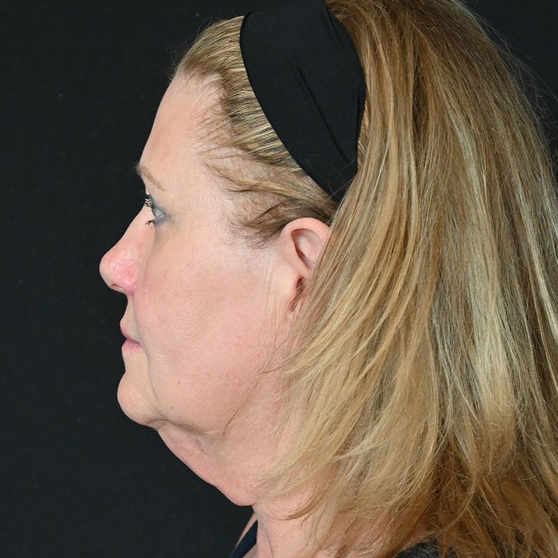 Neck Lift Before & After Gallery - Patient 341446 - Image 1