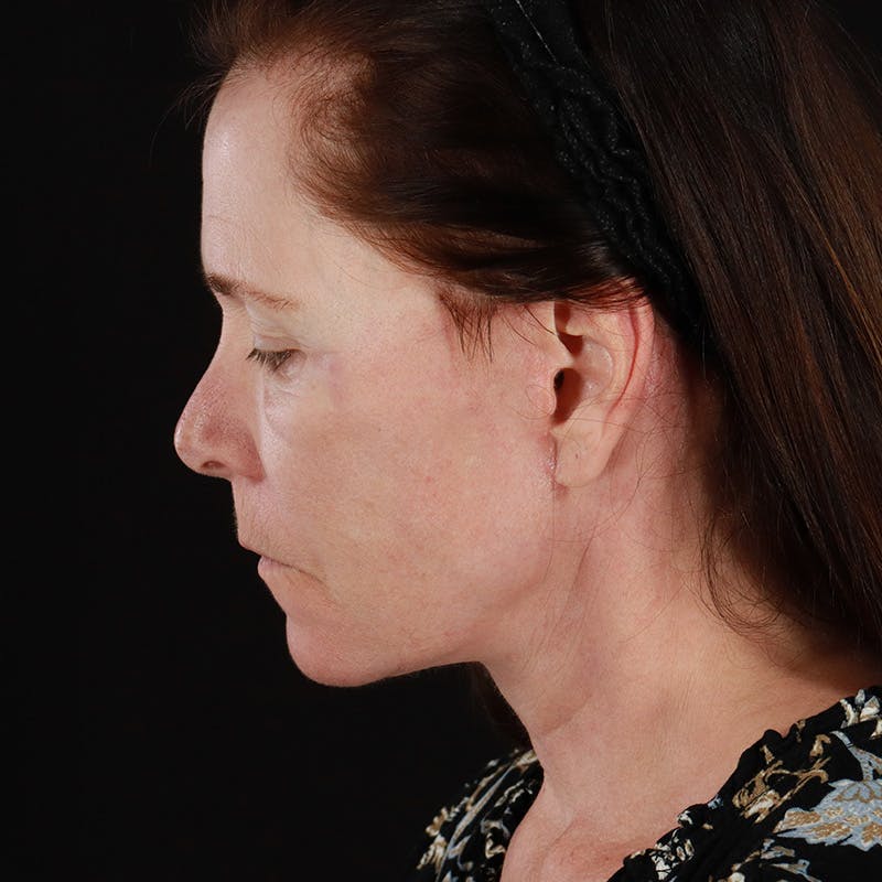 Facial Fat Grafting Before & After Gallery - Patient 160102 - Image 14