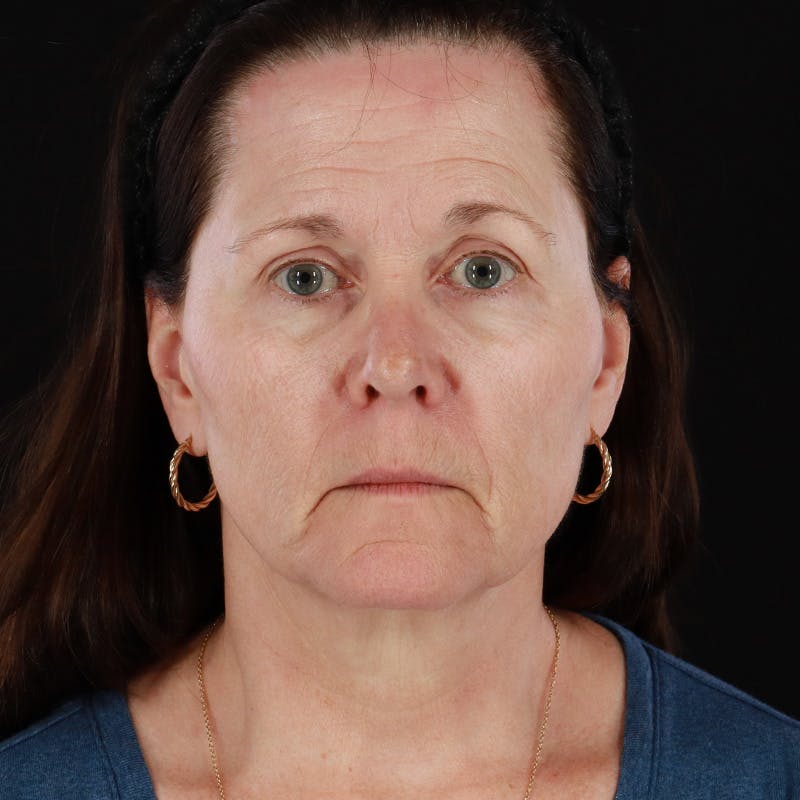 Facelift Before & After Gallery - Patient 114497 - Image 1