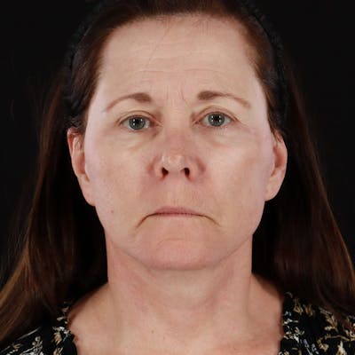Facial Fat Grafting Before & After Gallery - Patient 160102 - Image 2