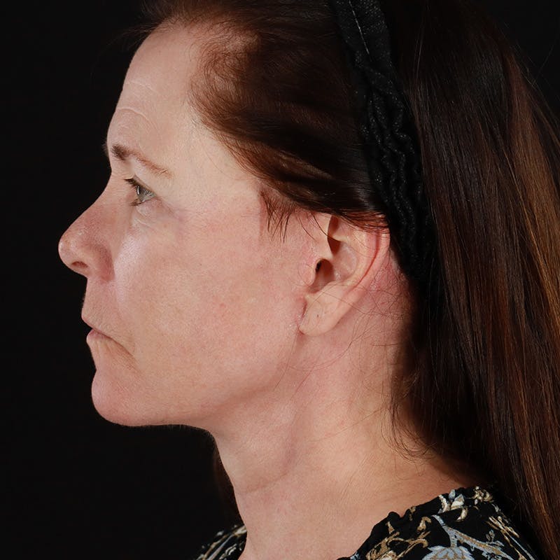 Facelift Before & After Gallery - Patient 114497 - Image 12